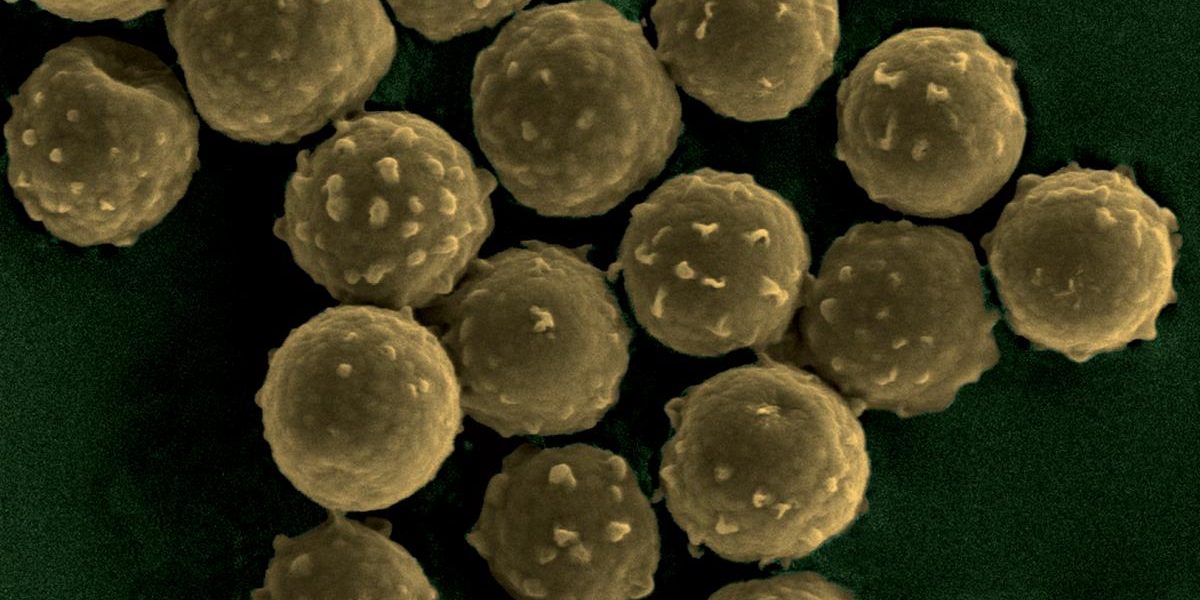 ast67-FCE-aspergillose